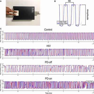 Quantitative Digitography Measures Fine Motor Disturbances in Chronically Treated HIV Similar to Parkinson’s Disease